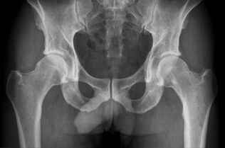 options for diagnosing osteoarthritis of the hip joint
