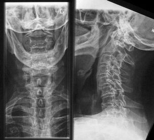 X-ray of the cervical spine a method for diagnosing osteochondrosis