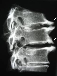 Osteophytes of the cervical spine cause neck pain
