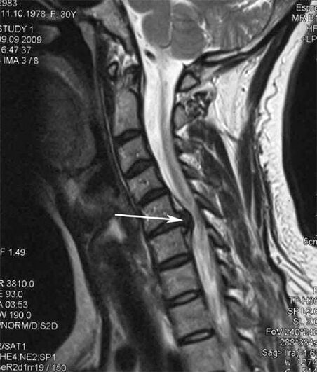 Spinal cord damage causes neck pain
