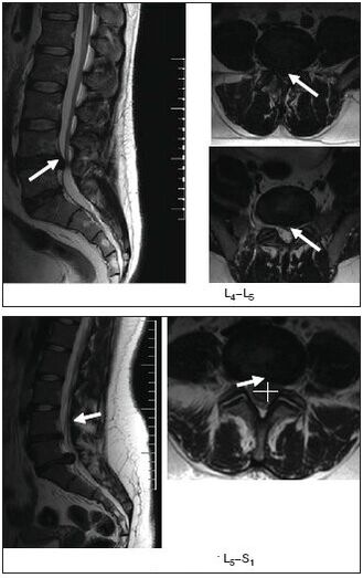 MRI of the herniated disc of the spine