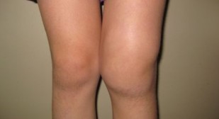 The deformation of the knee