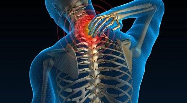 Spinal osteochondritis