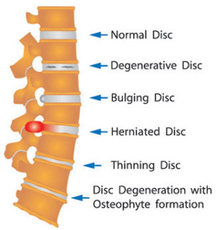 the damage of the disc of the spine
