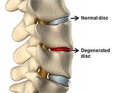 the normal disc of the spine, a damaged disk